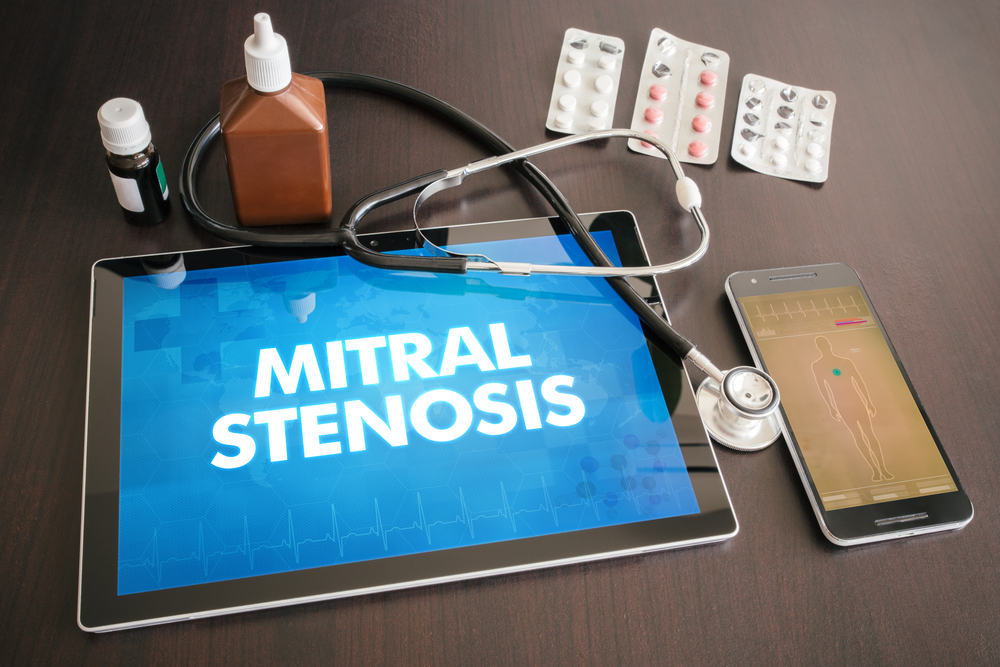 How To Diagnose Mitral Stenosis