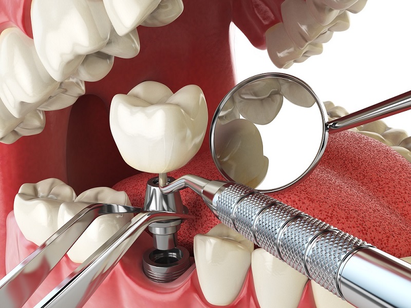 EXPLAINING DENTURE IMPLANTS OVER DENTURES AND BRIDGES