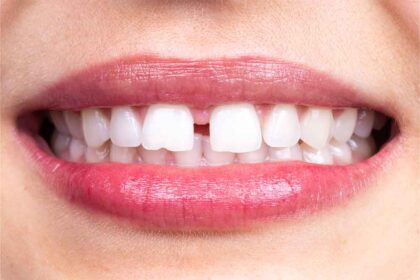 The 3 Best Methods for Closing Dental Gaps