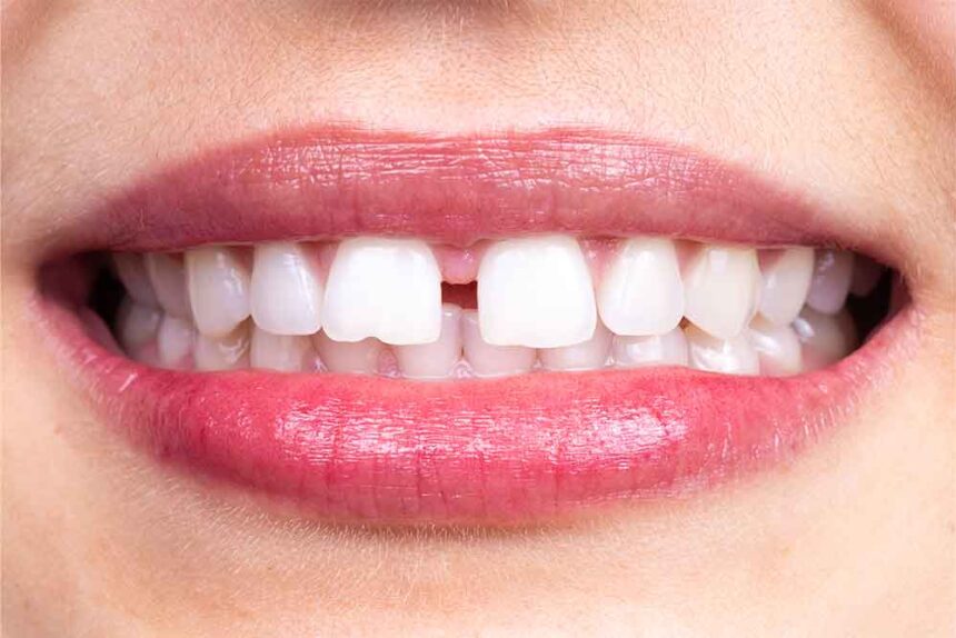 The 3 Best Methods for Closing Dental Gaps