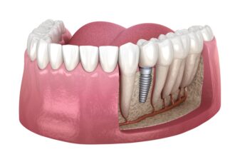 The Importance of Timely Denture Repair and Maintenance