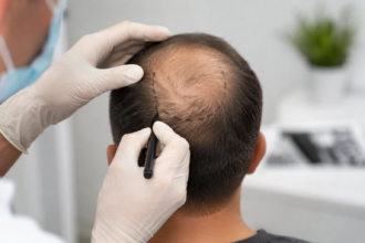 Hair Transplant Gold Coast for Crown Hair Loss